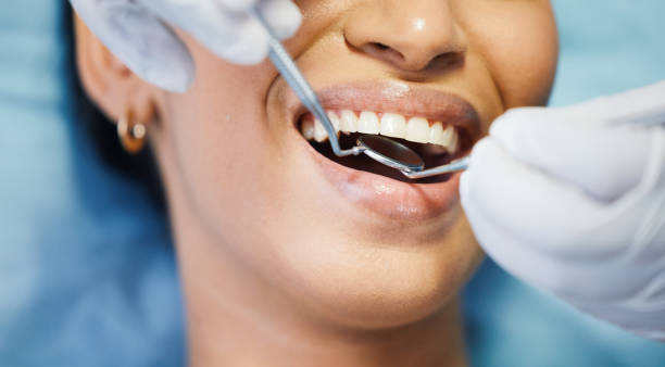 Best Emergency Wisdom Tooth Extraction in Conestee, SC